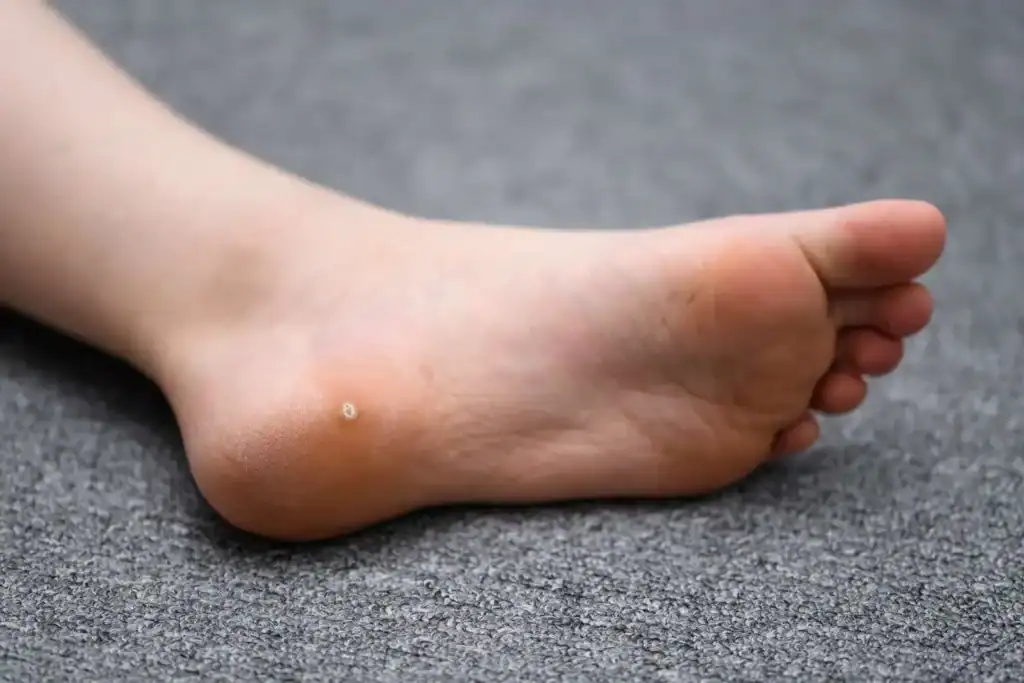 Cryotherapy For Warts And Also Verrucas 2 Image of verruca on the bottom of the foot that able to be treated with Cryotherapy Essex