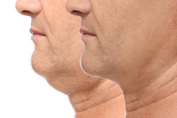 HIFU - Breakthrough in Anti - ageing 2 hifu results Essex