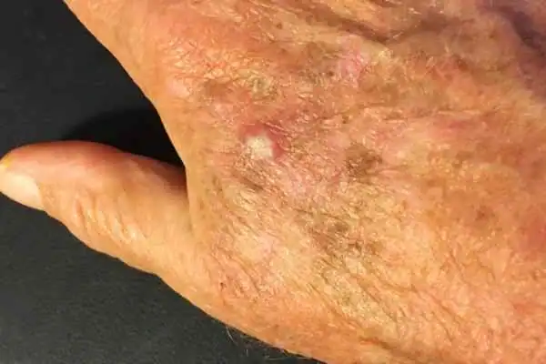 Image of Actinic keratoses Essex on a person hand