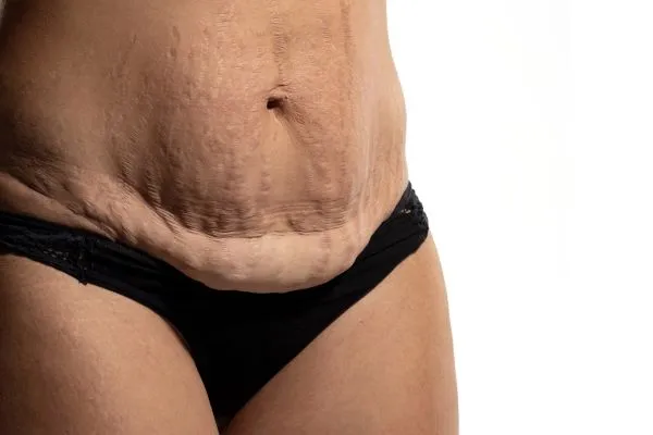 The science behind skin tightening Essex picture of a woman's sagging skin on the stomach
